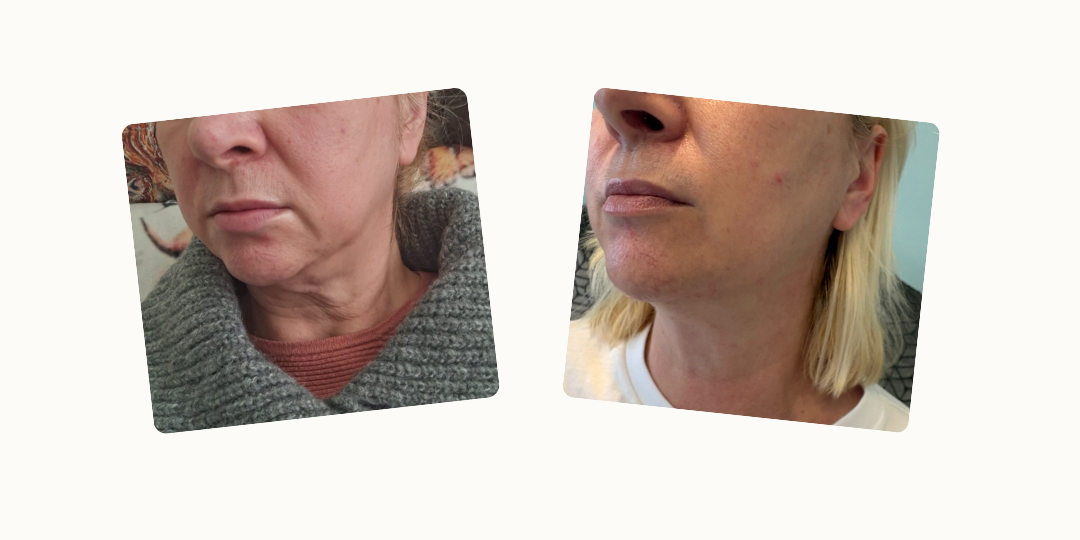 Before and after a Turkey Neck Rescue treatment showing tightened neck skin