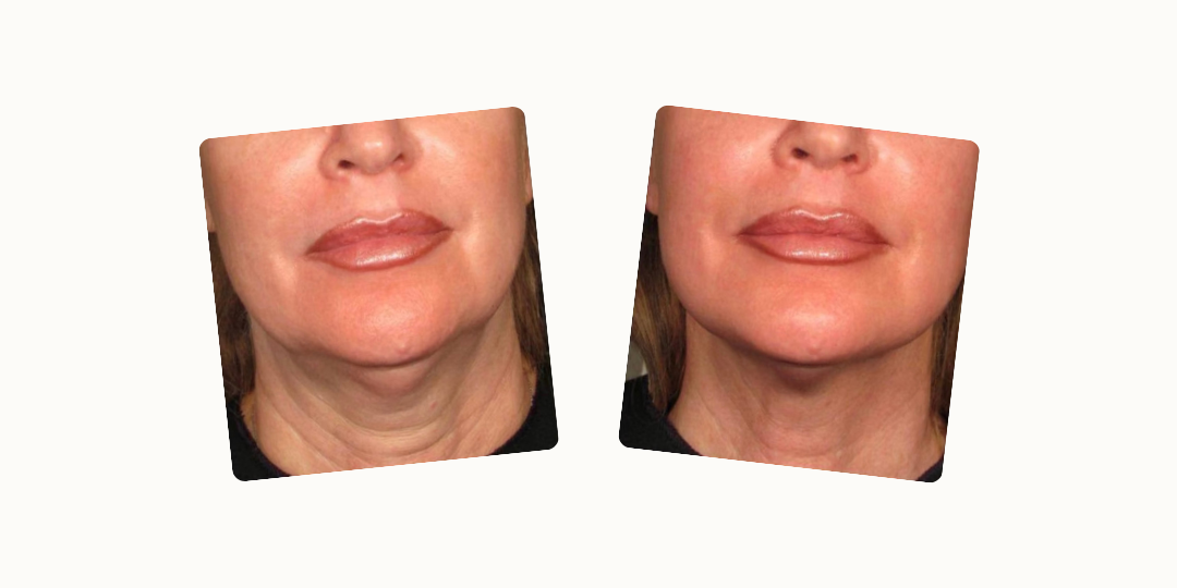 Before and after a Turkey Neck Rescue treatment showing tightened neck skin