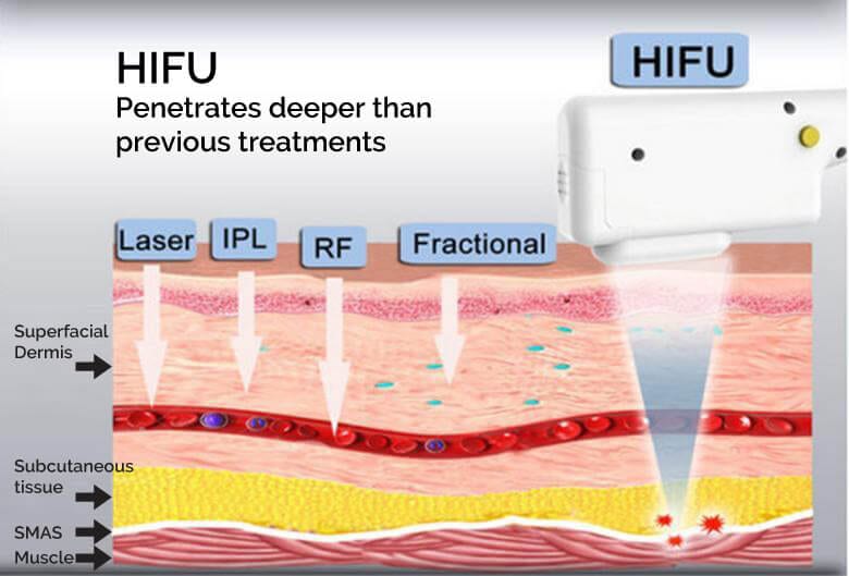 Diagram showing HIFU ultrasound penetrating deeper than Laser, IPL, RF and Fractional treatments to reach the SMAS layer